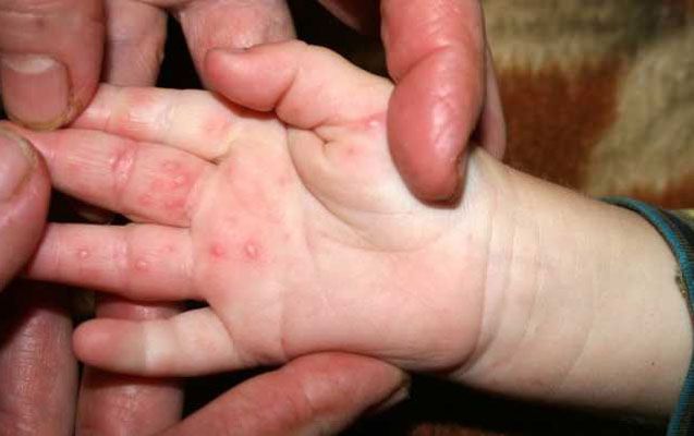 Azərbaycanda yeni virus yayıldı –     DİQQƏT