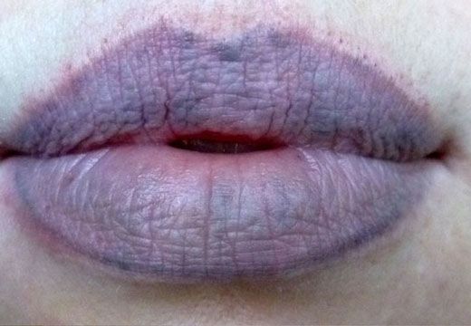 Koronavirusun daha bir simptomu üzə çıxdı:      Dodaqların göyərməsi…