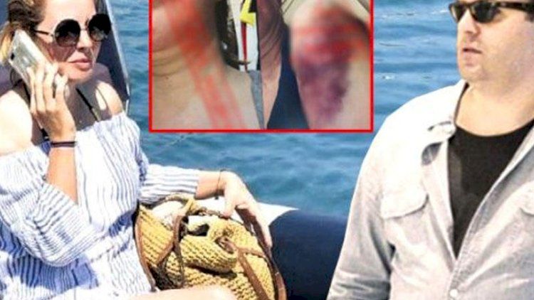 Keçmiş nazirin oğlu arvadını döyüb, qabırğalarını sındırdı -     FOTO