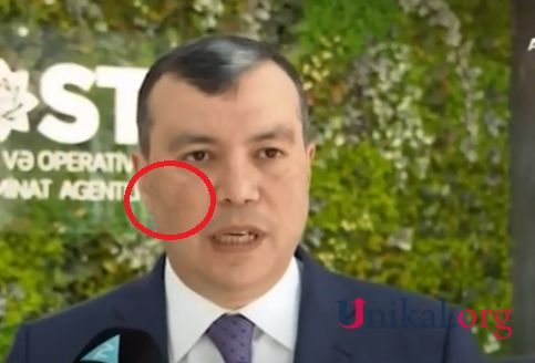 Sahil Babayevin xəstəliyinin adı bilindi -       FOTO