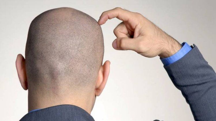 Saç tökülməsi problemi olanların nəzərinə! Bunu sınayanlar keçəllikdən XİLAS OLUR