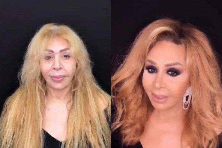 Əməkdar artist estetik əməliyyatın qurbanı oldu:     "Çox peşmanam..."
