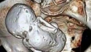 9 il ölü körpəsini bətnində gəzdirən ana öldü -         FOTO — foto 2