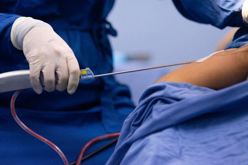 Liposaksiya əməliyyatının ölümcül riskləri:     Professor xəbərdarlıq etdi