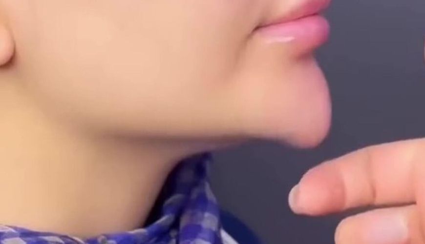 Bakıda üzünə dolğu etdirən qadının çənəsi əyildi -     FOTO