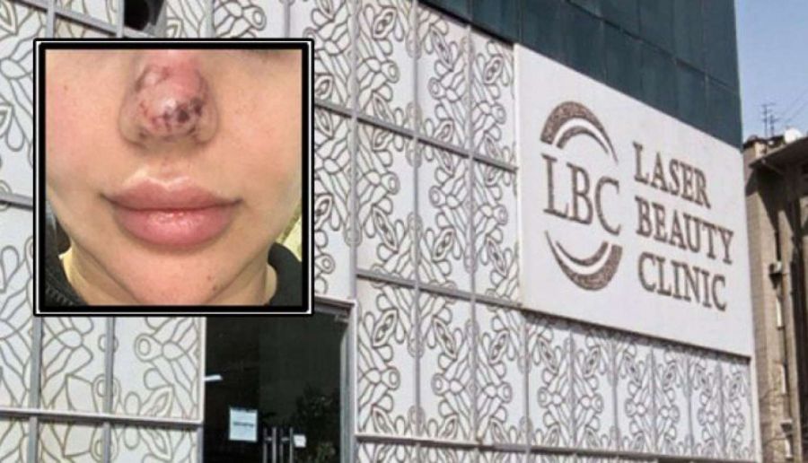 "Əməliyyatdan 4 gün sonra burnum qaraldı, 5 ay işə çıxa bilmədim" - Daha bir "estetika" dəhşəti -         FOTO